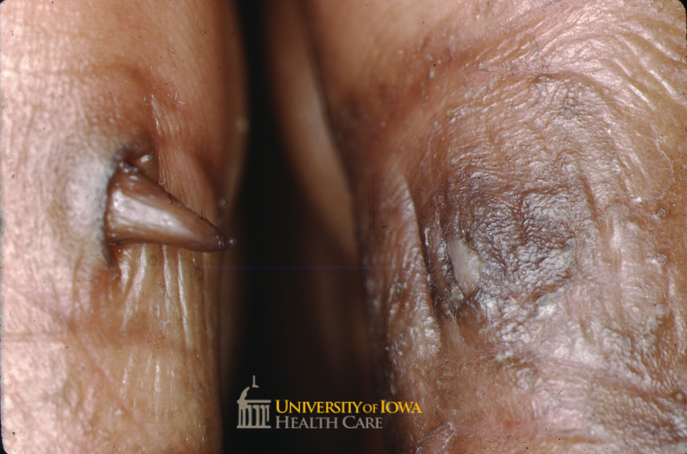 Elongated conical keratotic projection on the right lateral 5th digit and keratotic papule with surrounding hyperpigmentation on the left lateral 5th digit. (click images for higher resolution).